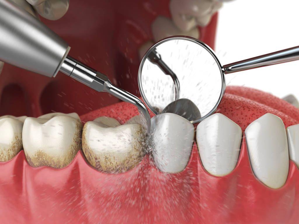 牙石是怎样形成的？如何防治？