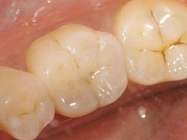 复合树脂补牙怎么样？